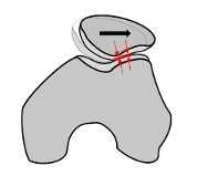 Lateral side of knee